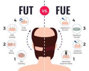 FUT vs FUE diagram