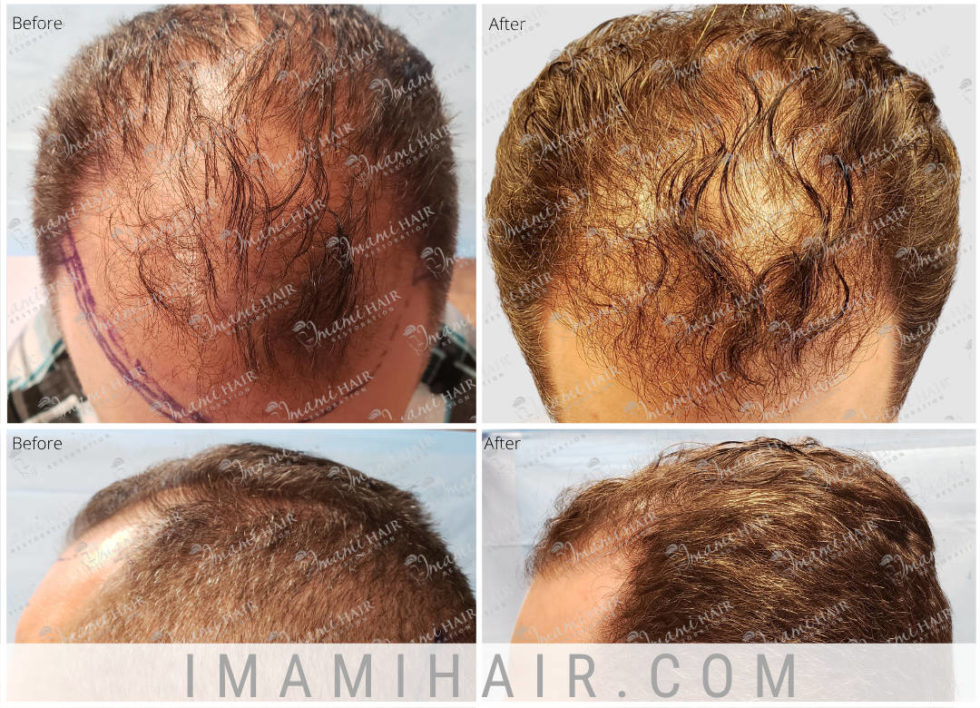 Imami Hair Restoration Hair Transplants And Hair Loss Treatments