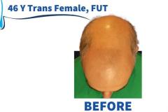 56 Y Trans Female, FUT