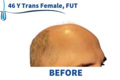 46 Y Trans Female FUT